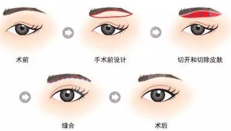 切眉術(shù)