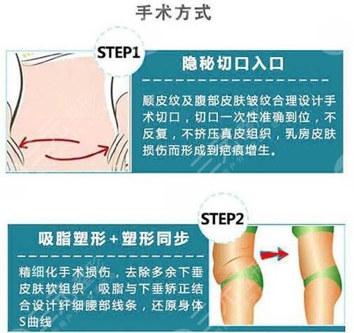 腰腹抽脂腹壁整形恢復期要多久？重塑小蠻腰，這些事你要知道！