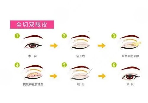 沈陽曙光醫(yī)療美容醫(yī)院雙眼皮價(jià)格多少