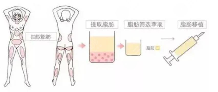 脂肪隆胸