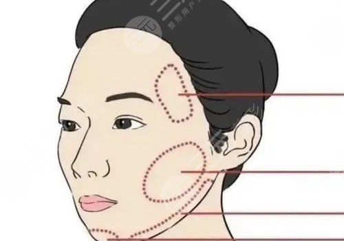 輪廓固定提升多少錢做一次好？
