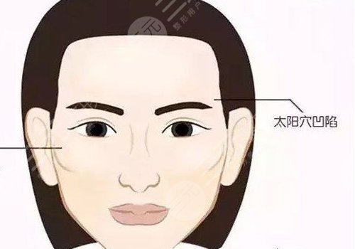 玻尿酸填充太陽凹大概多少錢？