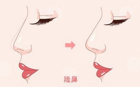 北京王志堅(jiān)鼻修復(fù)案例