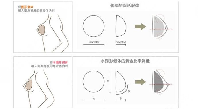 隆胸