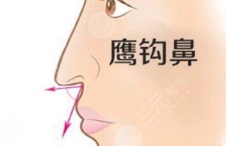 鷹鉤鼻