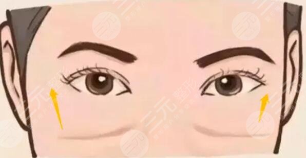 去眼袋