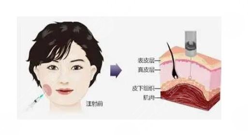 臉歪大小臉怎么矯正？