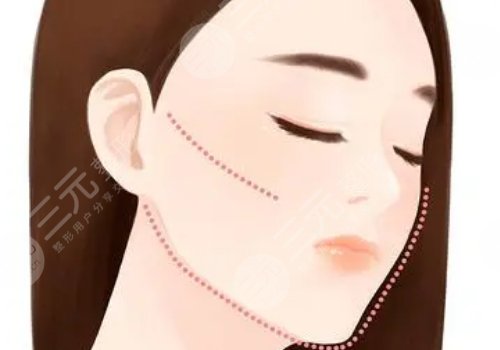 做完輪廓手術(shù)臉更大了怎么回事？