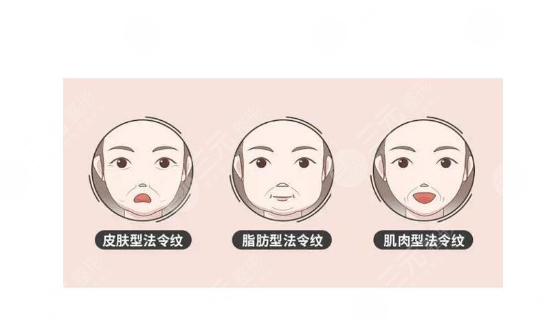 法令紋填充多少錢一針？