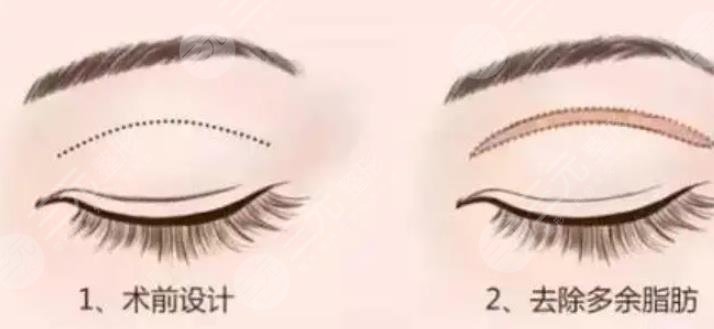 全切雙眼皮