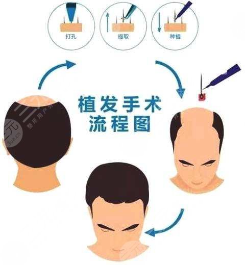 北京醫(yī)院植發(fā)需要多少錢?