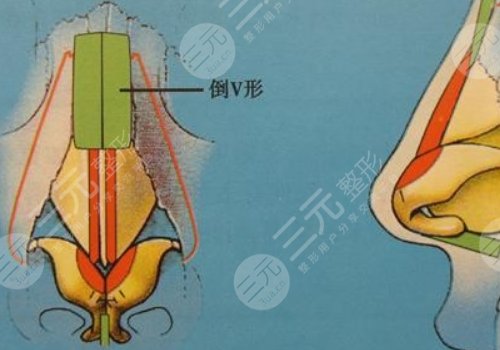 媽生鼻多少錢