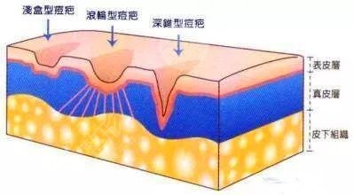 北京大學(xué)第一醫(yī)院點(diǎn)陣激光去痘疤案例分享|術(shù)后恢復(fù)圖