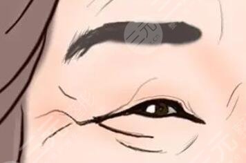 魚尾紋