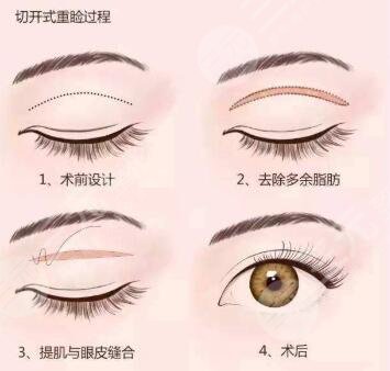 北京空軍總醫(yī)院整形科雙眼皮手術(shù)案例