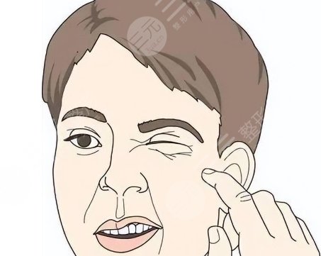 面癱后遺癥