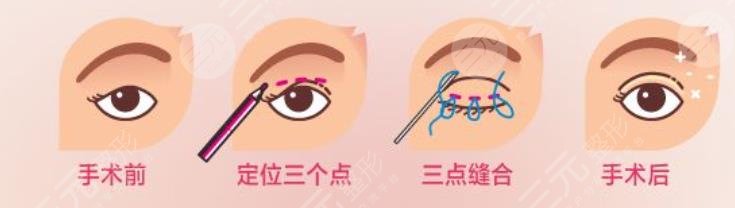 修復(fù)雙眼皮