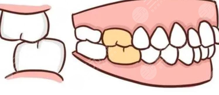 牙齒矯正