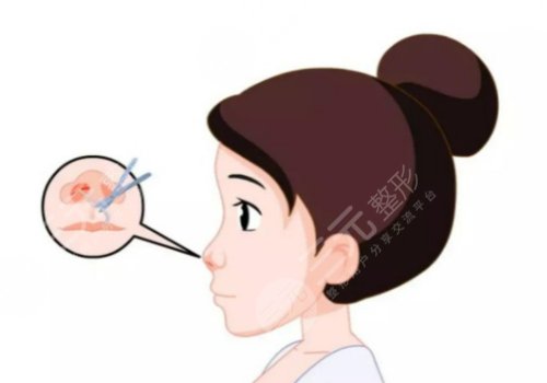珠江醫(yī)院王晉煌做鼻子怎么樣
