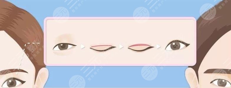 雙眼皮