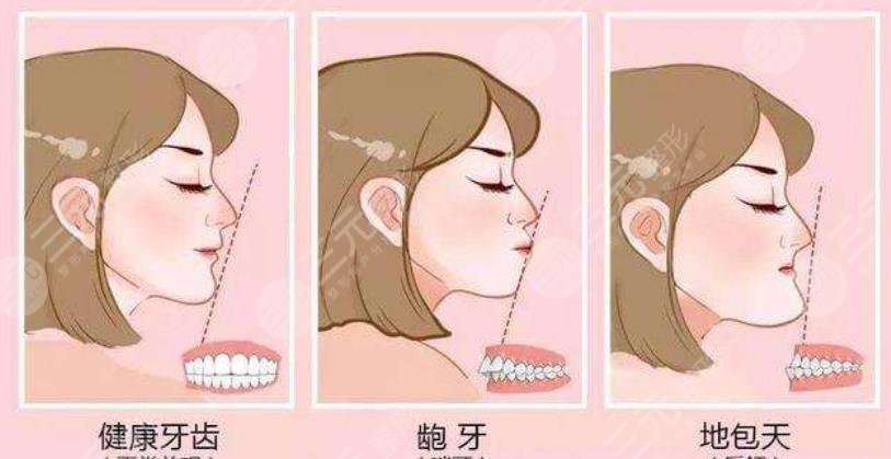 上海華山醫(yī)院牙齒矯正案例