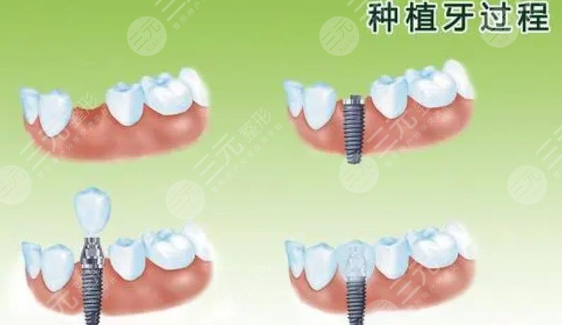 上海第十人民醫(yī)院種牙案例