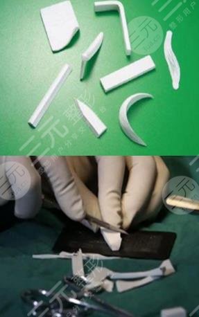 上海同濟醫(yī)院整形外科假體隆鼻案例