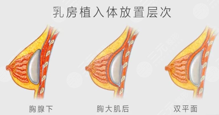 假體隆胸術(shù)后可以哺乳嗎?
