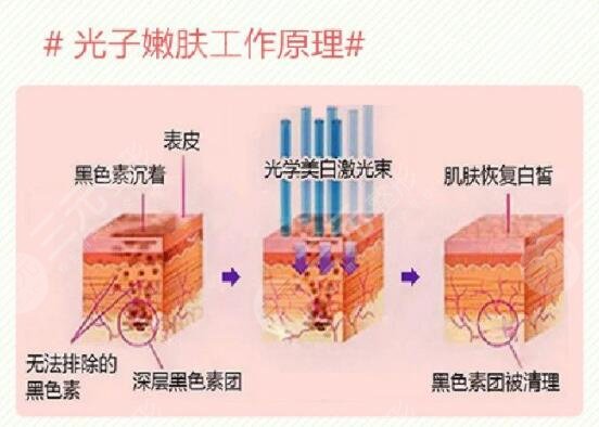 中關(guān)村醫(yī)院光子嫩膚案例分享