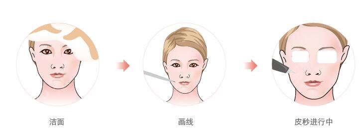 中關(guān)村醫(yī)院光子嫩膚案例分享