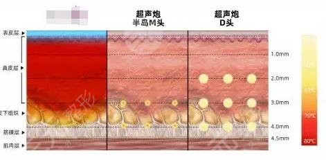 半島黃金超聲炮和超聲炮的區(qū)別有哪些？