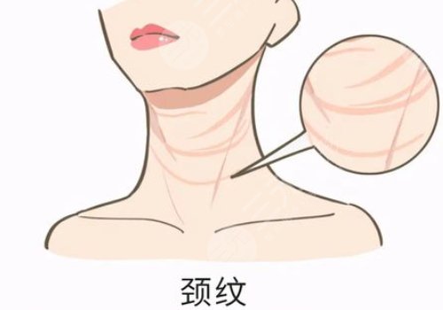 頸部皮膚松弛有什么辦法可以改良？