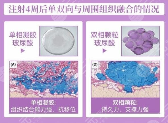 婕爾玻尿酸有后遺癥嗎？