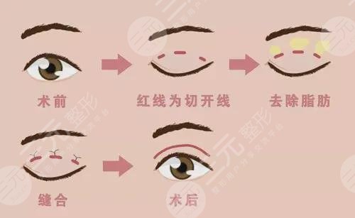 眼周老化問題怎么解決？