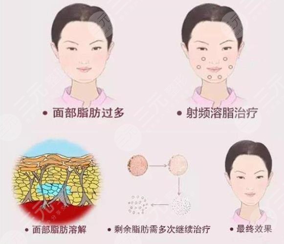黃金脂雕和黃金微雕的區(qū)別