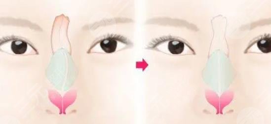 歪鼻