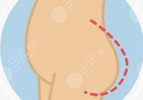 脂肪豐臀多久能恢復(fù)好？