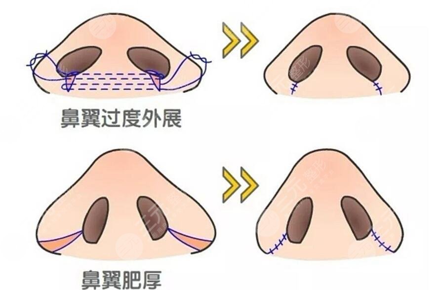 縮小鼻子