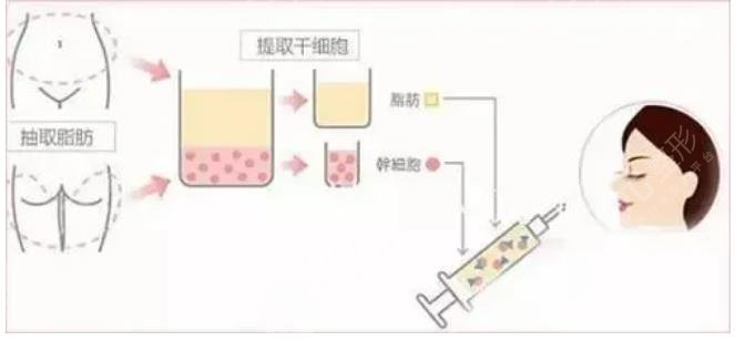 宋建星醫(yī)生自體脂肪填充案例