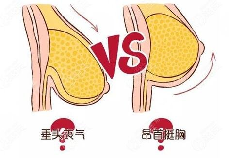 胸下垂懸吊手術怎樣護理?