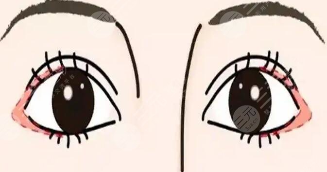 開(kāi)眼角