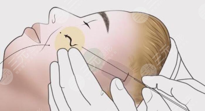 除皺