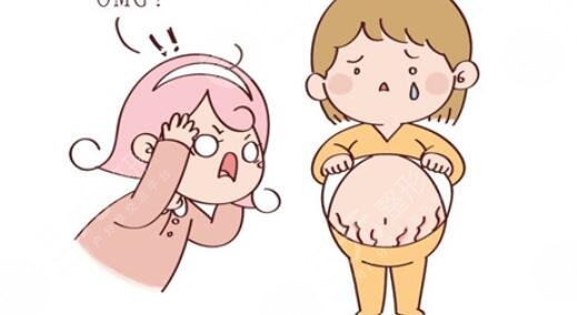 妊娠紋