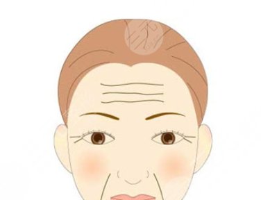 額頭表情紋