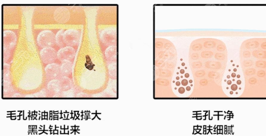 果酸換膚