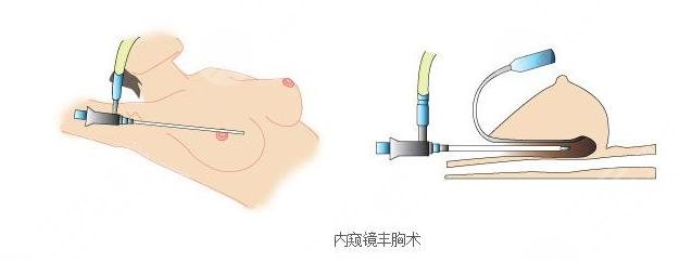內(nèi)窺鏡