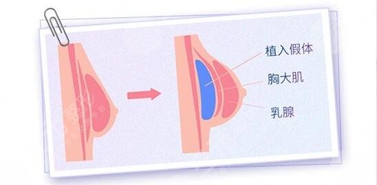毛面假體