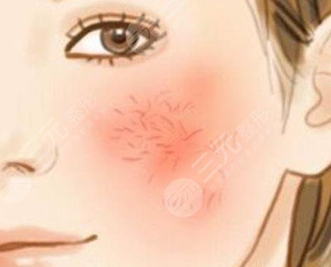 紅血絲