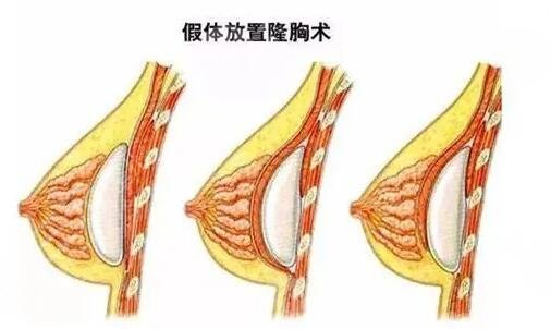 韓國蓓拉假體的價格貴嗎？