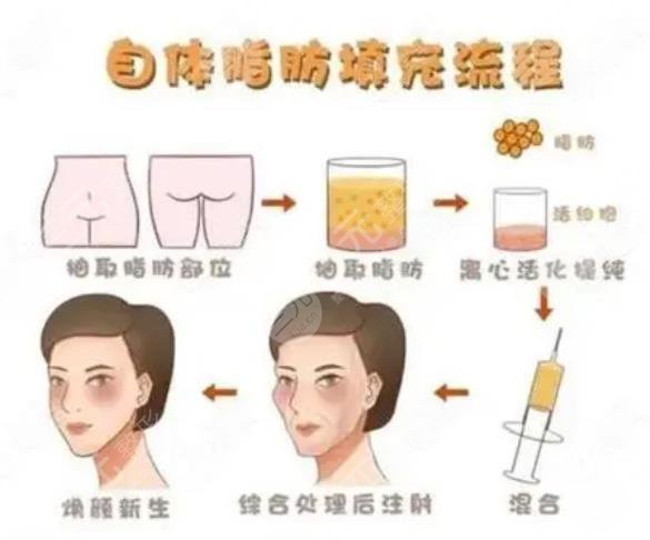 脂肪填充